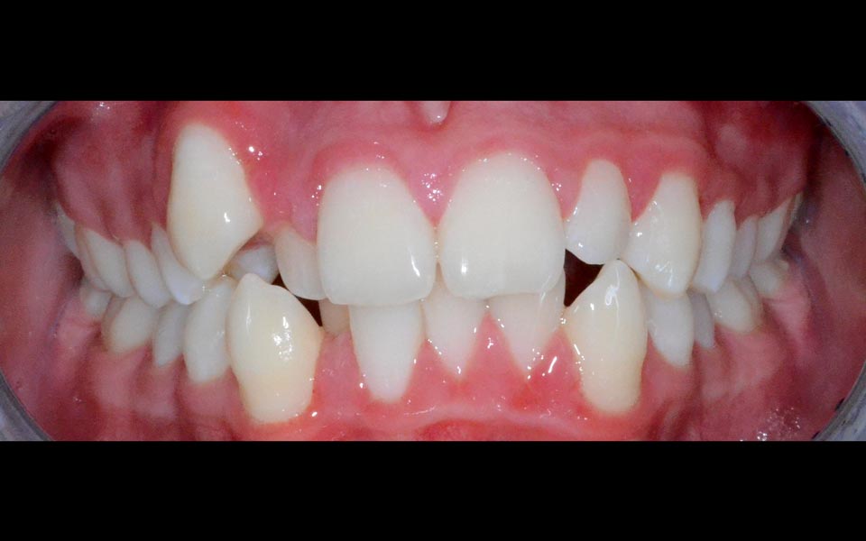 Crowded teeth before