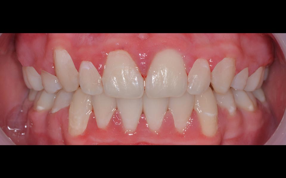 Crowded teeth after