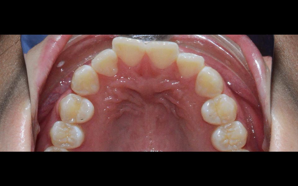 Orthodontic relapse before